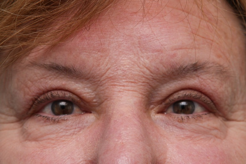 Upper Blepharoplasty Before & After Patient Photo