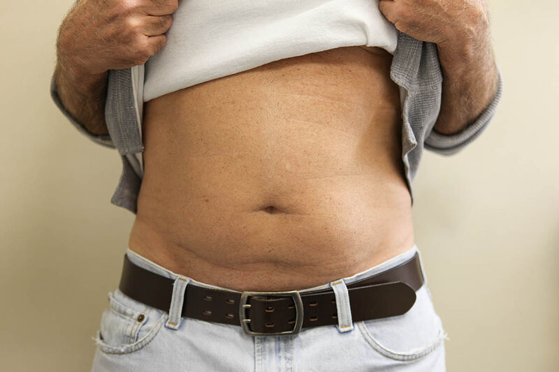 Coolsculpting for Men Before & After Patient Photo