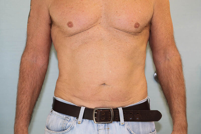 Coolsculpting for Men Before & After Patient Photo