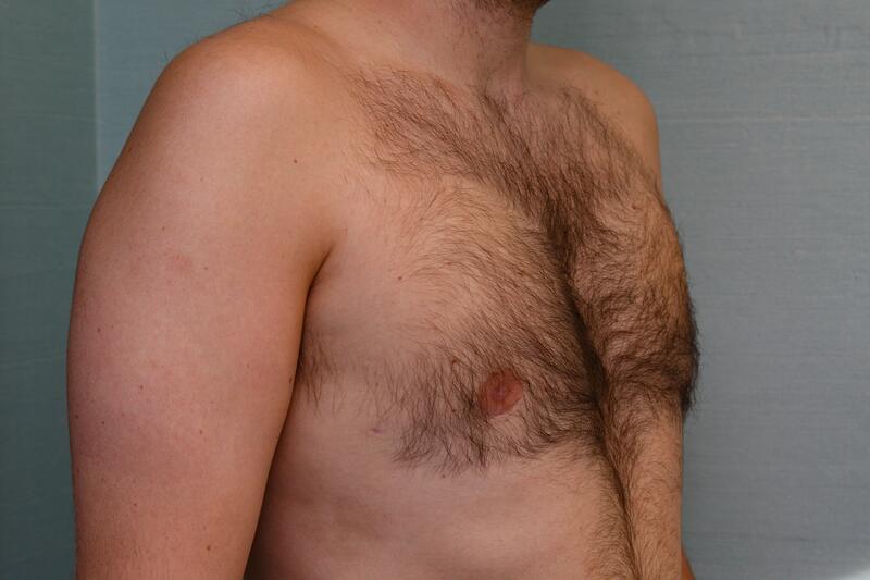 Gynecomastia Surgery Before & After Patient Photo