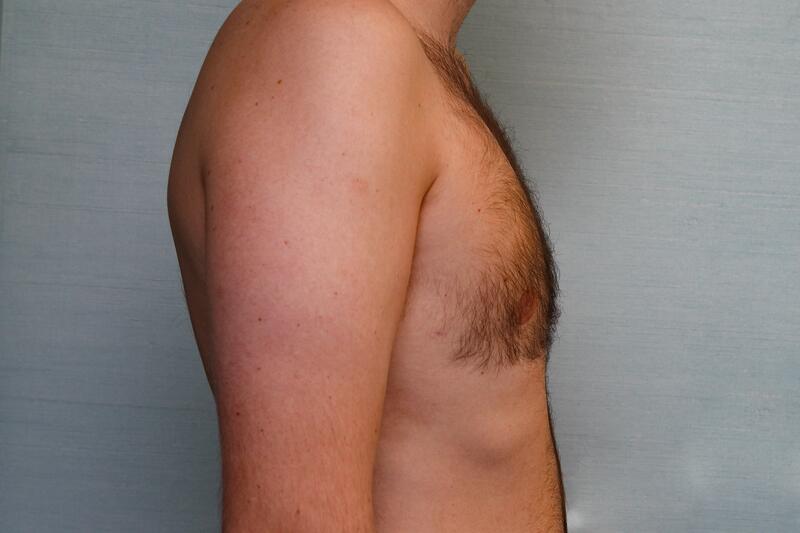 Gynecomastia Surgery Before & After Patient Photo
