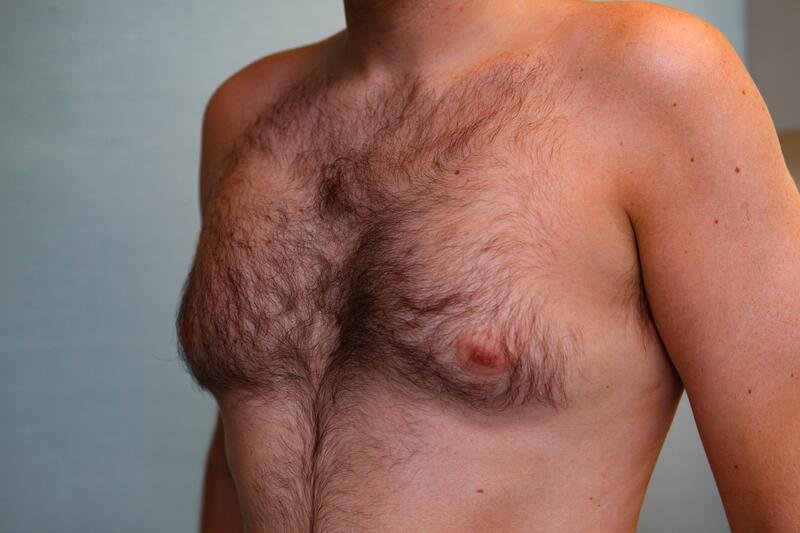 Gynecomastia Surgery Before & After Patient Photo