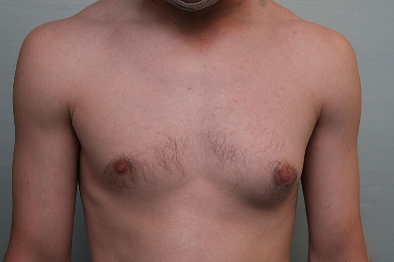 Gynecomastia Surgery Before & After Patient Photo