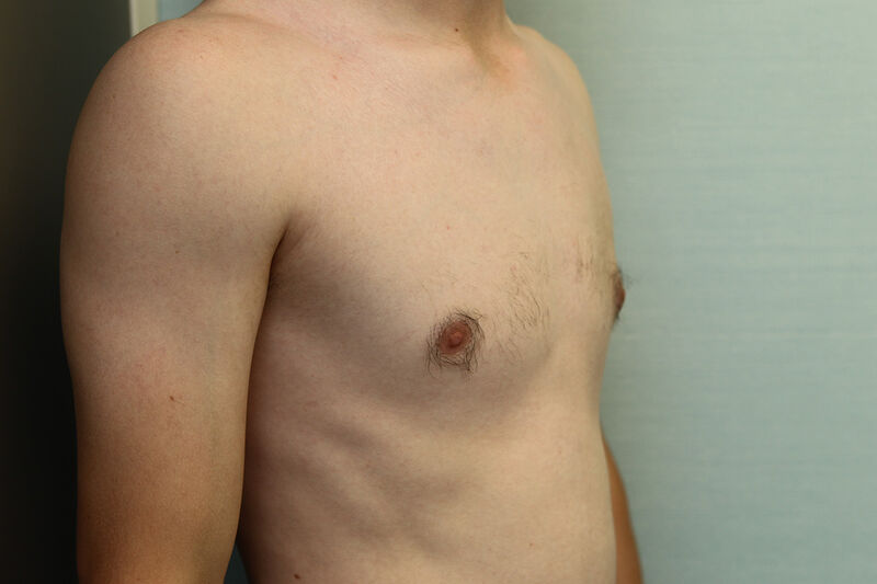 Gynecomastia Surgery Before & After Patient Photo