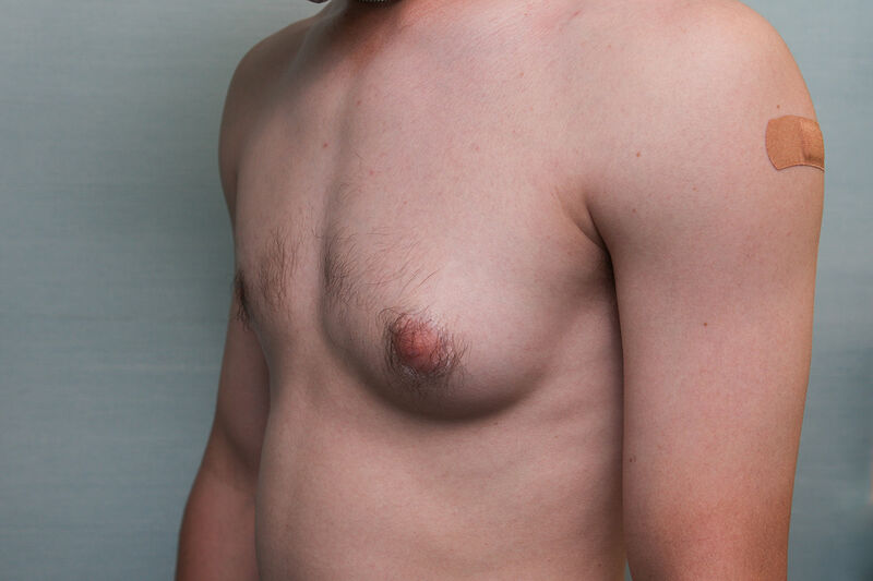 Gynecomastia Surgery Before & After Patient Photo