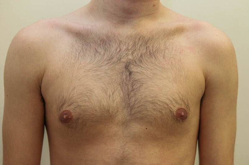 Gynecomastia Surgery Before & After Patient Photo