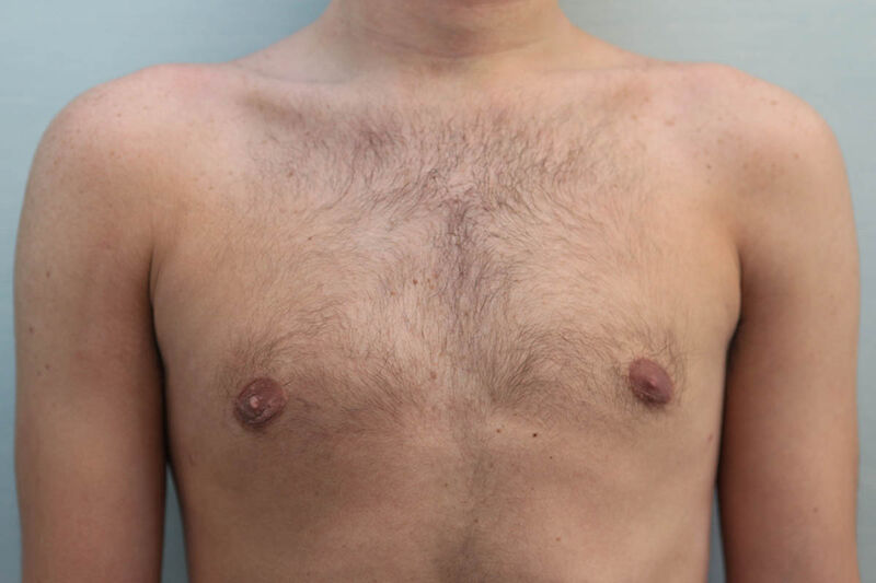 Gynecomastia Surgery Before & After Patient Photo