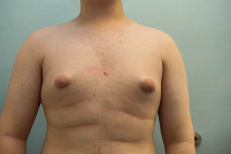 Gynecomastia Surgery Before & After Patient Photo