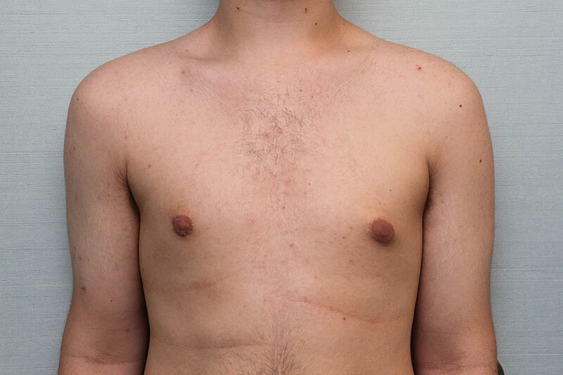 Gynecomastia Surgery Before & After Patient Photo