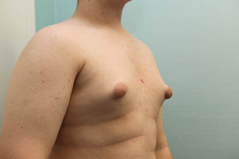 Gynecomastia Surgery Before & After Patient Photo