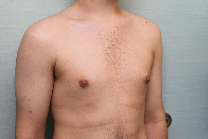 Gynecomastia Surgery Before & After Patient Photo