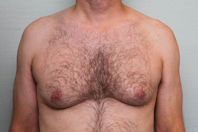 Gynecomastia Surgery Before & After Patient Photo