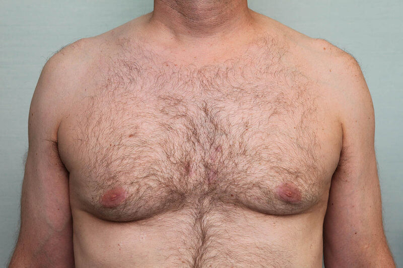 Gynecomastia Surgery Before & After Patient Photo