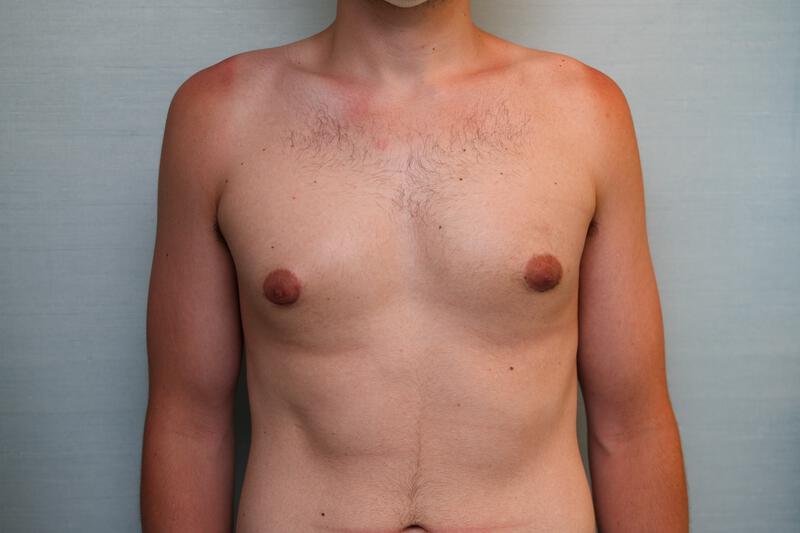 Gynecomastia Surgery Before & After Patient Photo