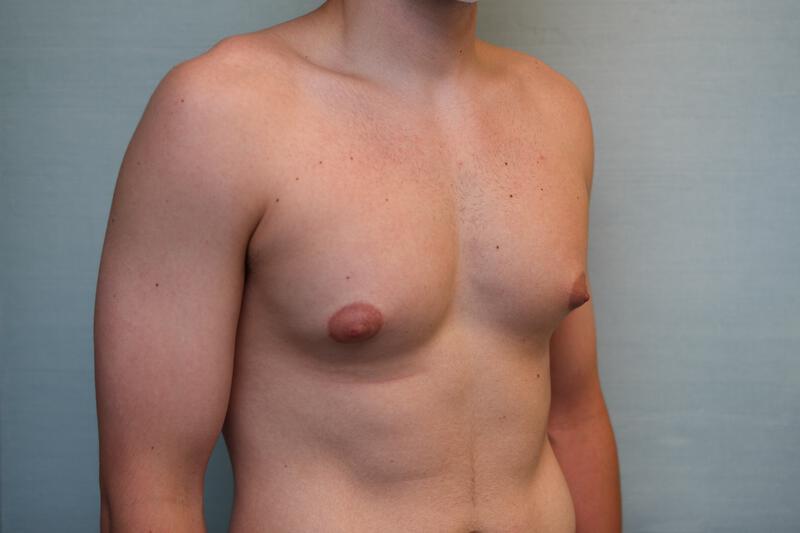 Gynecomastia Surgery Before & After Patient Photo