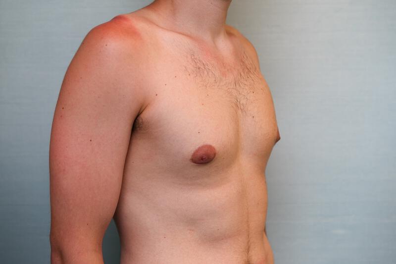 Gynecomastia Surgery Before & After Patient Photo