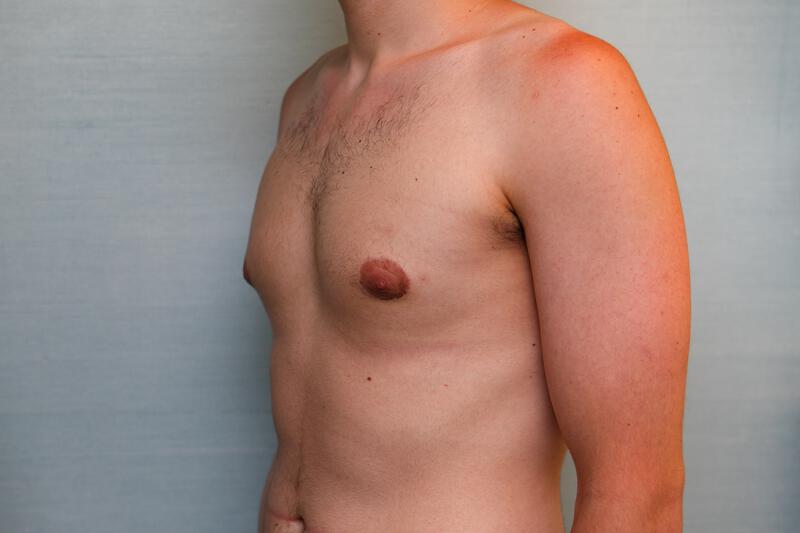 Gynecomastia Surgery Before & After Patient Photo