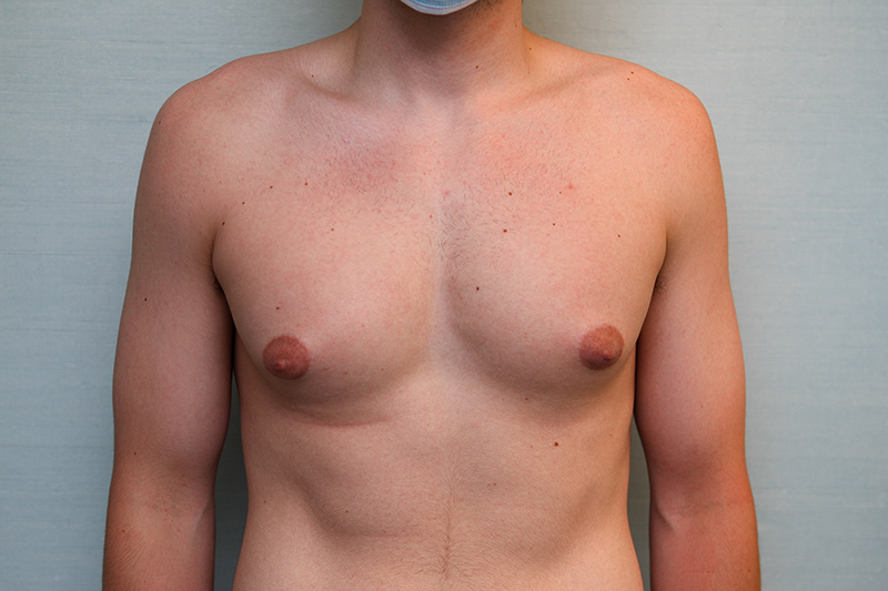 Gynecomastia Surgery Before & After Patient Photo