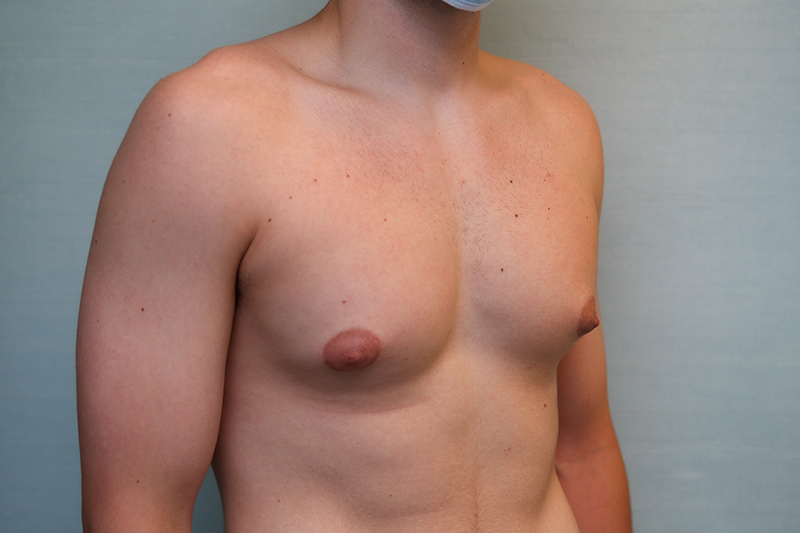 Gynecomastia Surgery Before & After Patient Photo