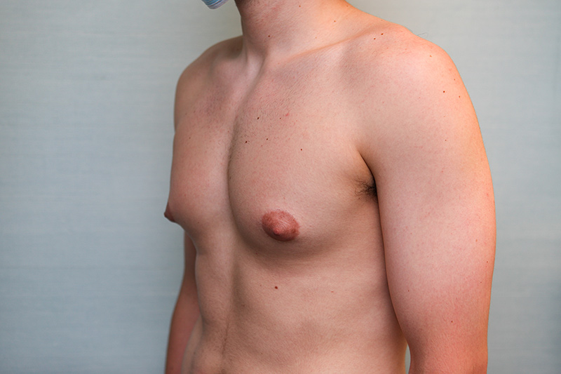 Gynecomastia Surgery Before & After Patient Photo