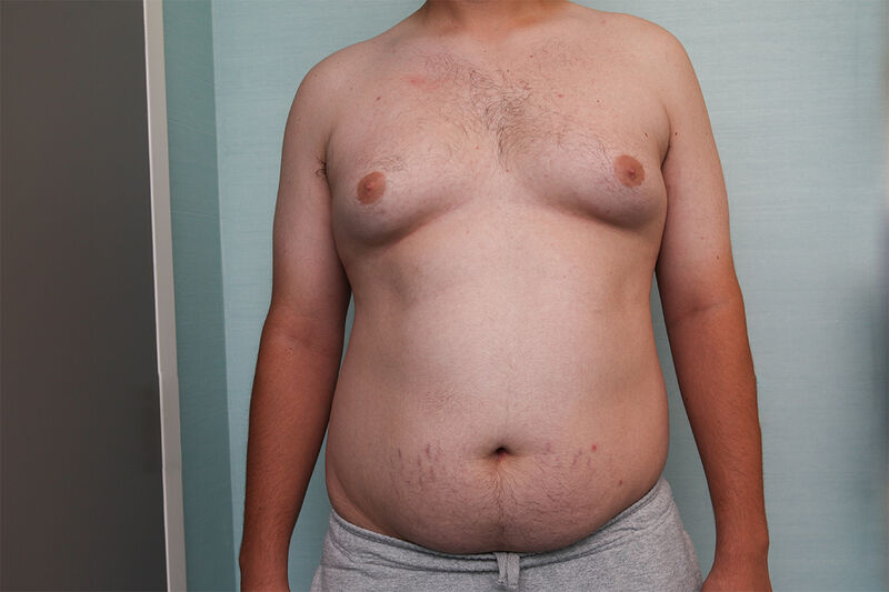 Liposuction Before & After Patient Photo