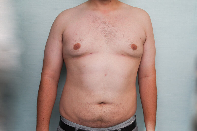 Liposuction Before & After Patient Photo