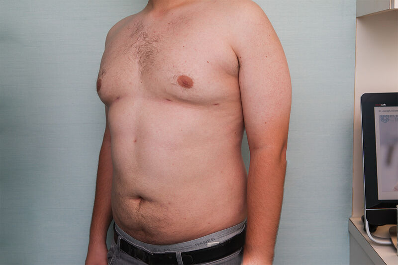 Liposuction Before & After Patient Photo