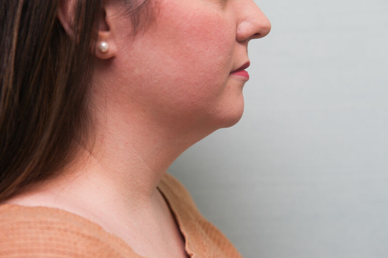 Accutite Before & After Patient Photo