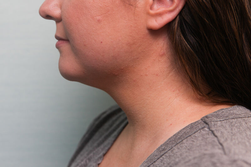 Accutite Before & After Patient Photo