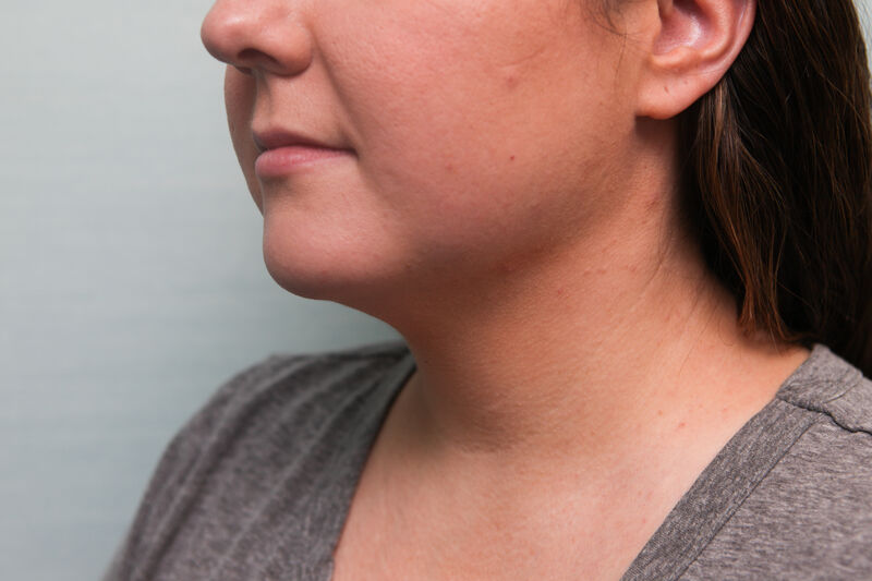 Accutite Before & After Patient Photo