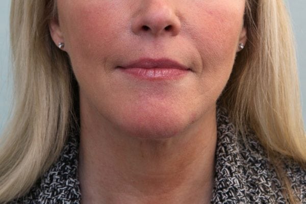 FaceTite Before & After Patient Photo