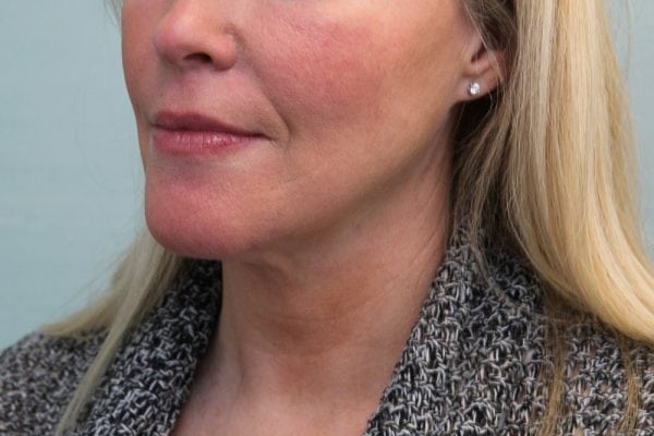 FaceTite Before & After Patient Photo