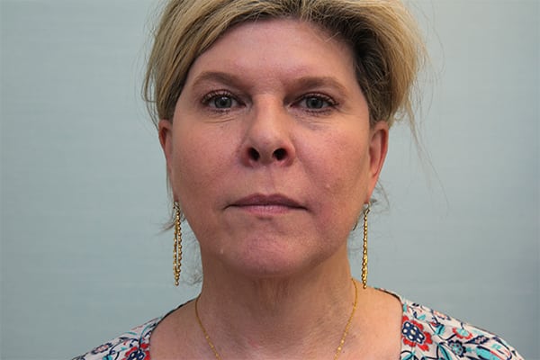 FaceTite Before & After Patient Photo