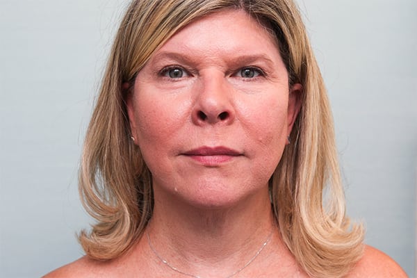 FaceTite Before & After Patient Photo