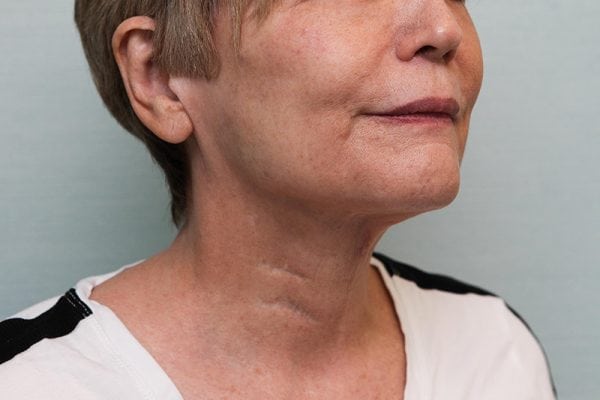 FaceTite Before & After Patient Photo