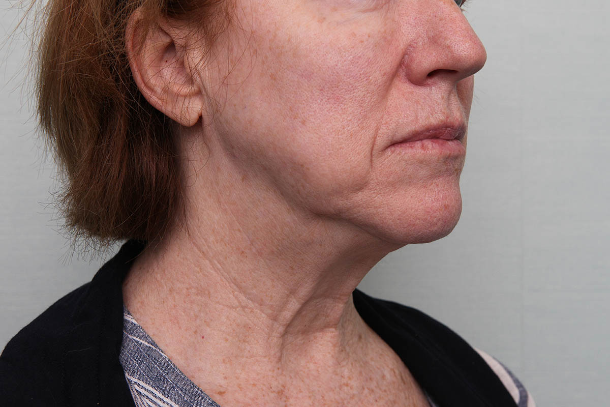 FaceTite Before & After Patient Photo