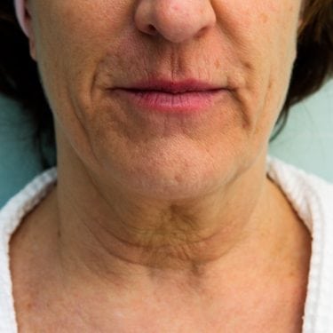 FaceTite Before & After Patient Photo