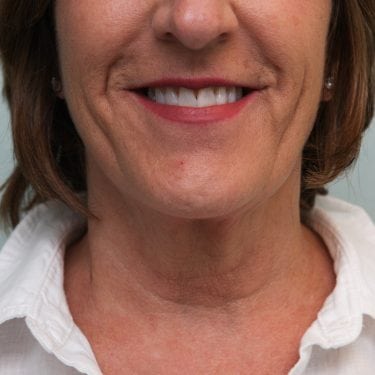FaceTite Before & After Patient Photo