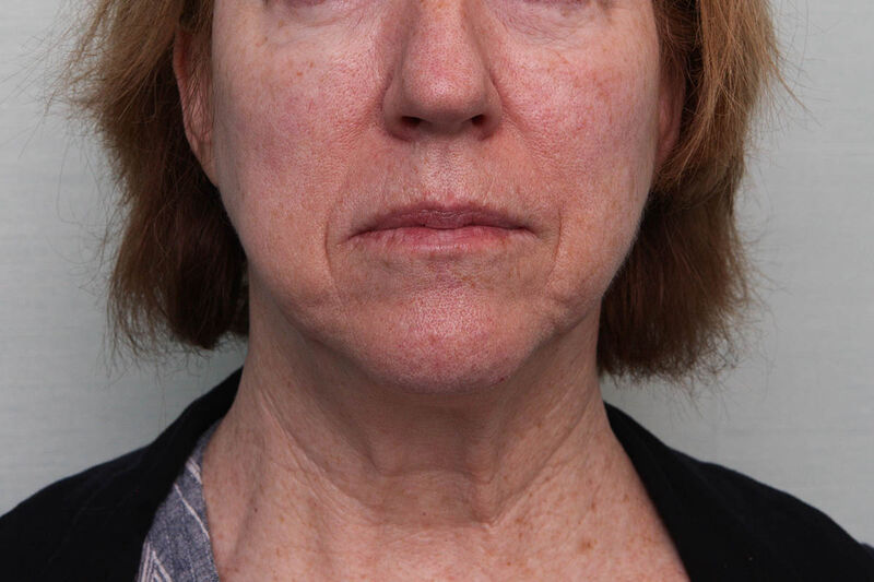 FaceTite Before & After Patient Photo