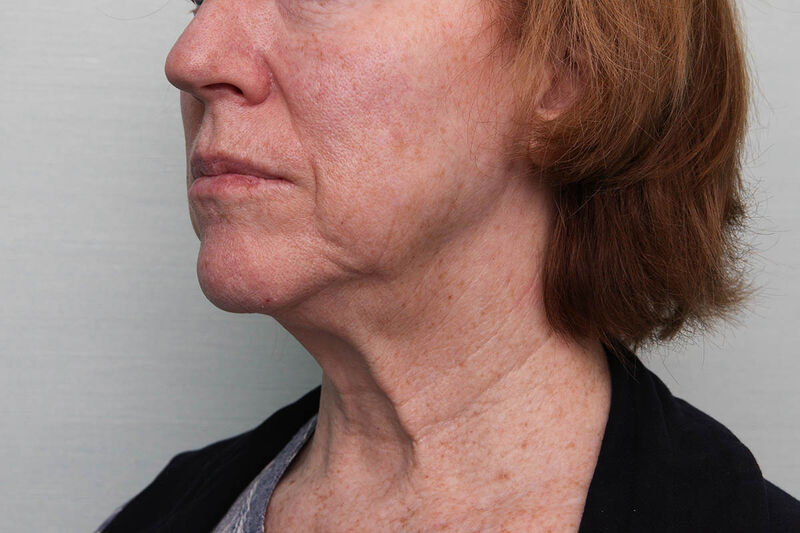 FaceTite Before & After Patient Photo