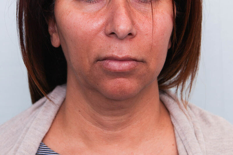 FaceTite Before & After Patient Photo