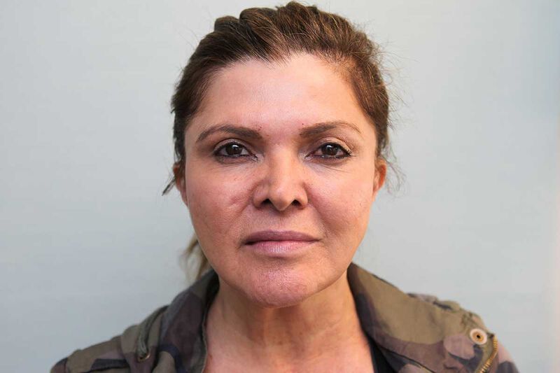 FaceTite Before & After Patient Photo