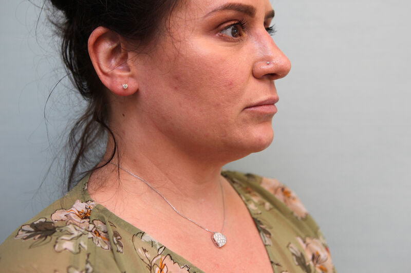 FaceTite Before & After Patient Photo