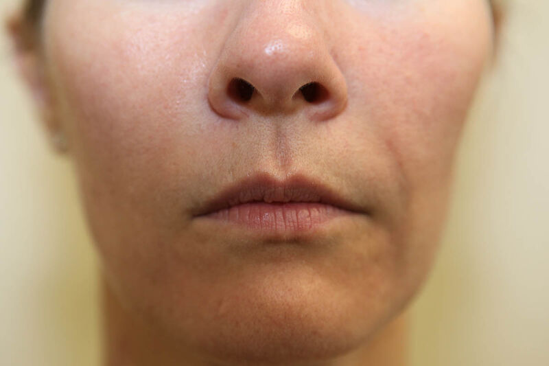 Fillers Before & After Patient Photo