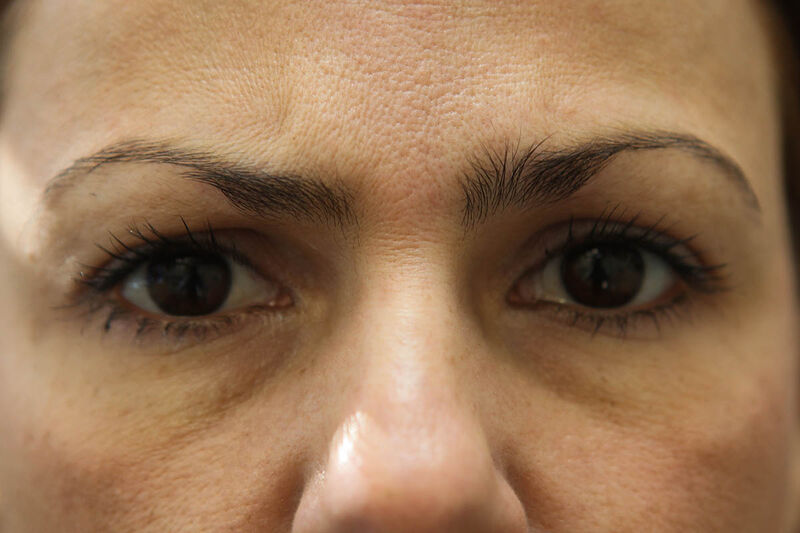 Fillers Before & After Patient Photo