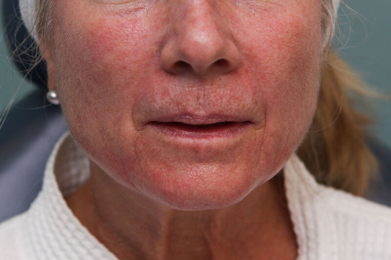 Laser Resurfacing Before & After Patient Photo