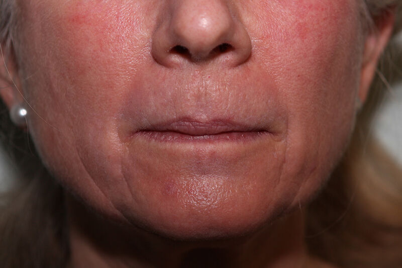 Laser Resurfacing Before & After Patient Photo