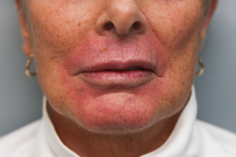 Laser Resurfacing Before & After Patient Photo