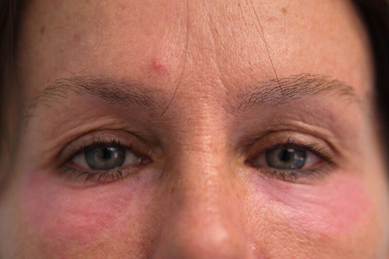 Laser Resurfacing Before & After Patient Photo