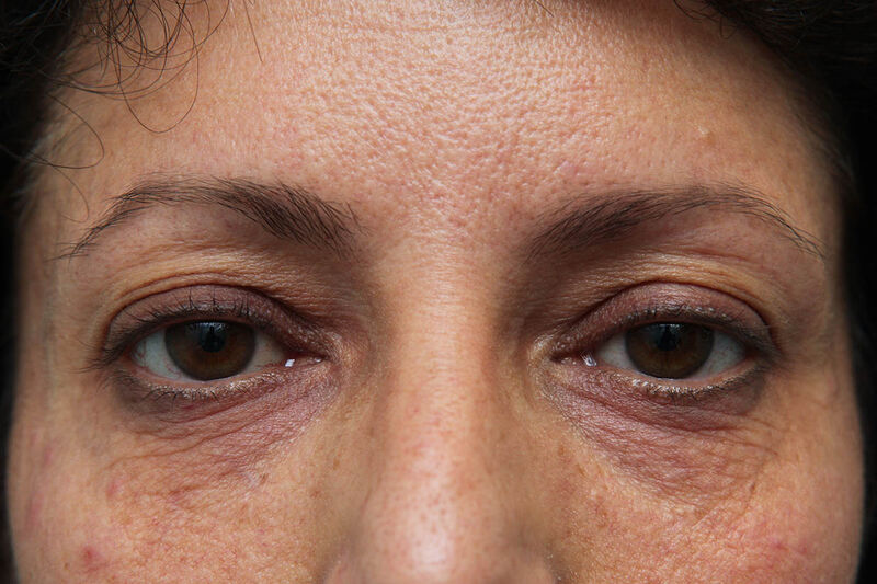 Laser Resurfacing Before & After Patient Photo